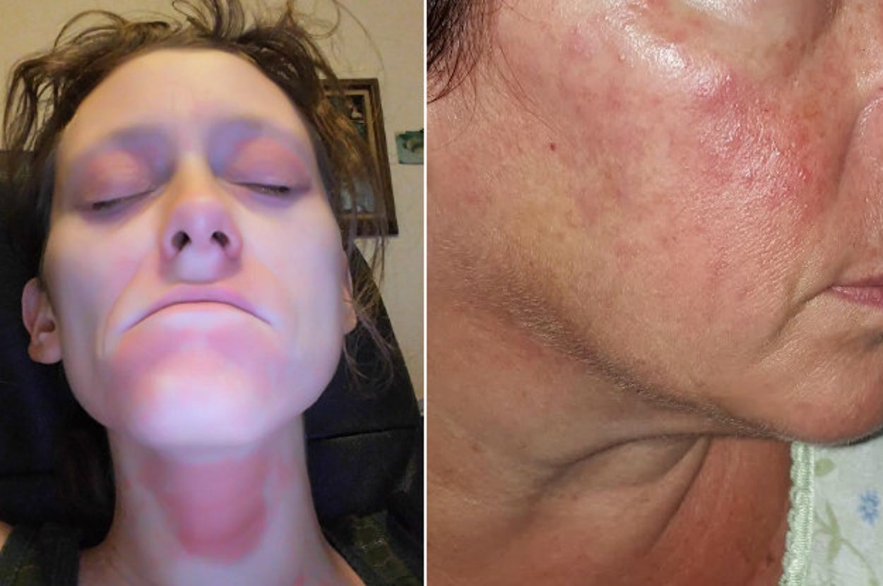 Why Neutrogena Face Wash with Salicylic Acid is Best for Oily, Acne-Prone Skin